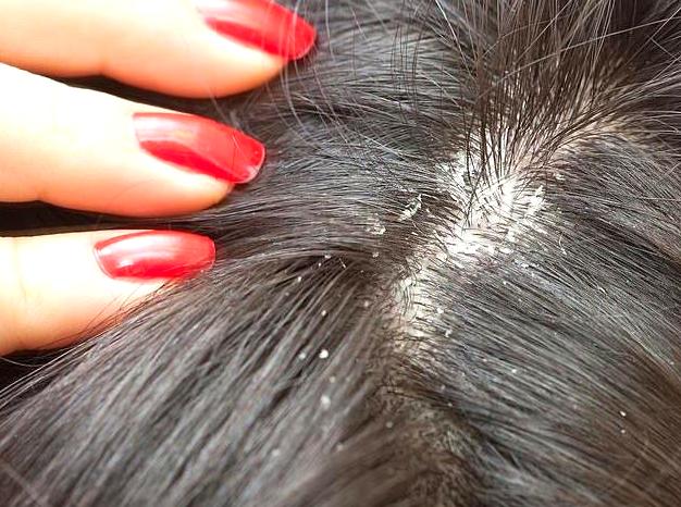 Why Scalp Health Matters