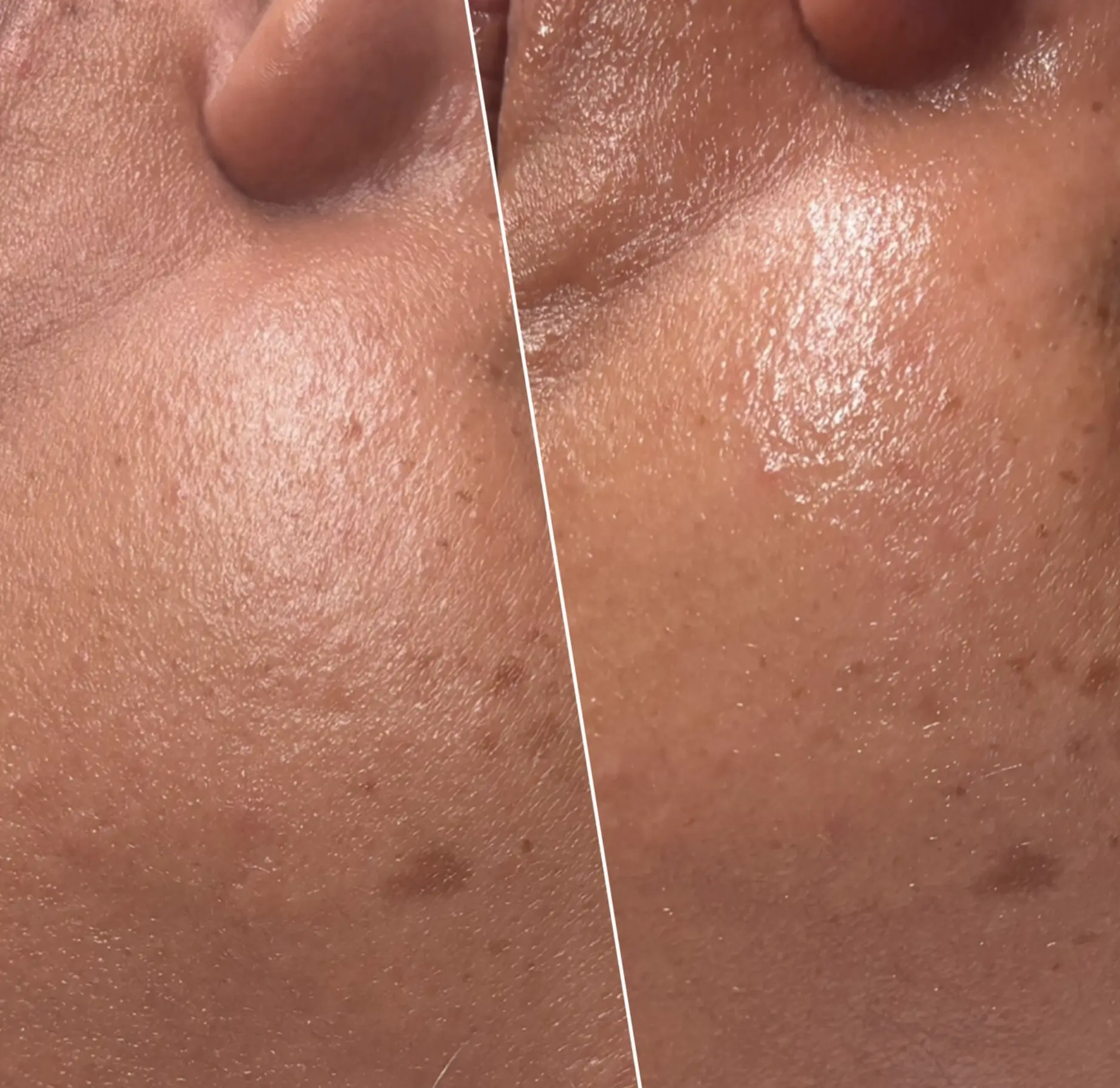 hydrafacial north brisbane